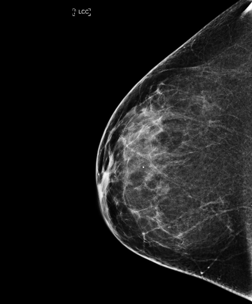 Mammografi. Foto: National Cancer Institute, National Institutes of Health